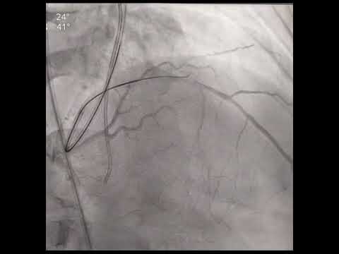 Use of Turnpike (micro catheter) in complex CTO