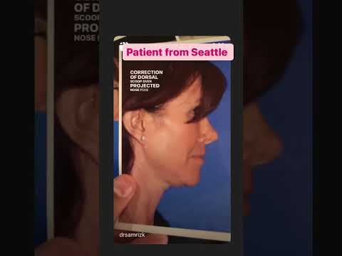 Watch Video: Deep Plane Facelift & Rhinoplasty Revision #1WeekLater