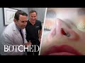 Botched Docs Worried About Patient S Thin Nose E