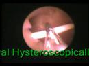 Hysteroscopic assessment related to intrauterine device CuT operative video