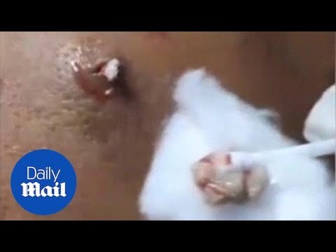 Dermatologist squeezes ten-year-old spot on man's back in Hanoi