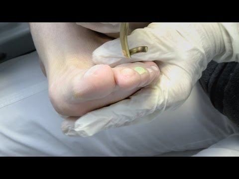 Die Abart gribka der Nägel und seine Behandlung Die Mittel gegen gribka an den Wänden in samare