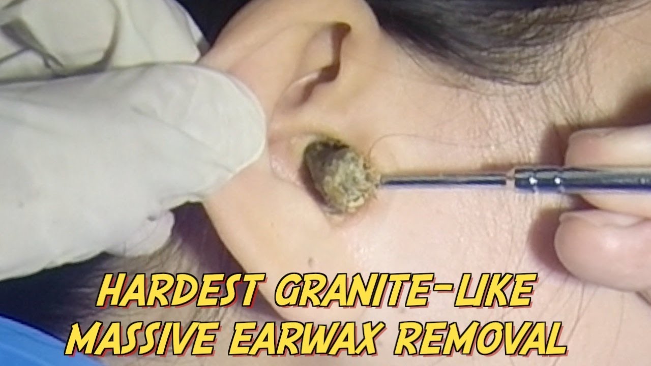 Hardest Granite-like Massive Earwax Removal