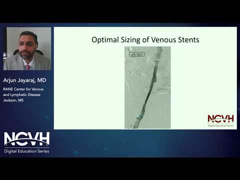 Dr. Arjun Jayaraj, Cross Sectional Area Should Guide Iliac Vein Stenting