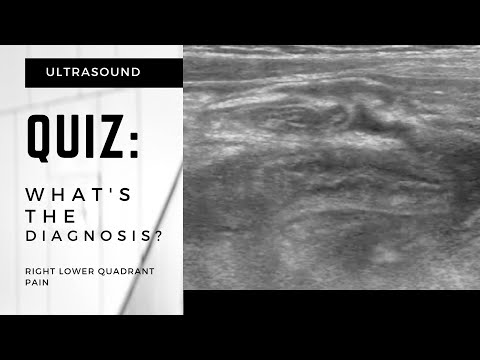 QUIZ - What's the Diagnosis? Right Lower Quadrant Pain (Ultrasound)