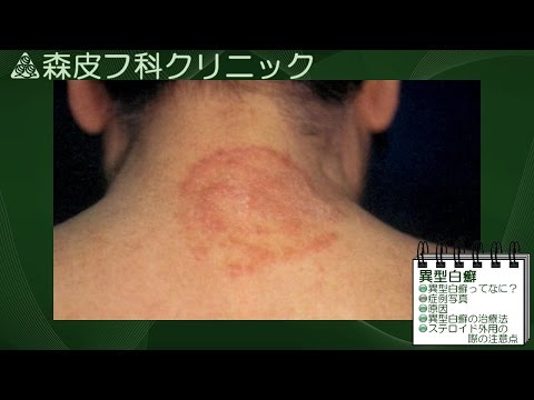 ピルラ・ピクタ