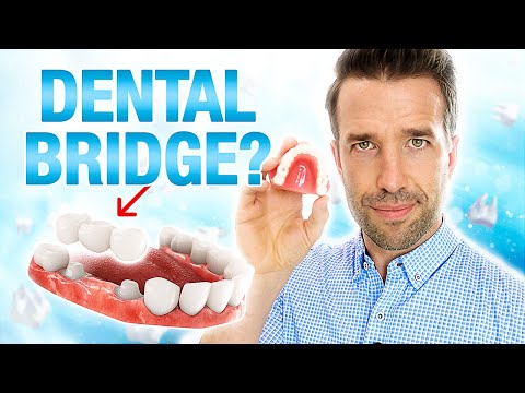 You Need to Know This About a Dental Bridge