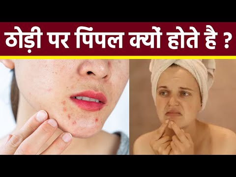 Chin पर Pimples होने का कारण | ठोड़ी पर पिंपल के उपाय |Boldsky
