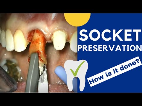 Tooth extraction and SOCKET PRESERVATION - How is it done?
