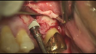 Download lagu Simple GBR case on maxillary 1st molar area mp3 Download lagu Simple GBR case on maxillary 1st molar area mp3