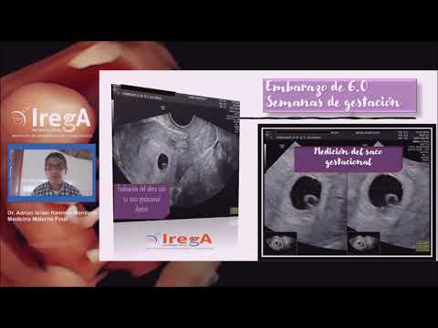 Early pregnancy - Maternal Fetal by IREGA IVF Acapulco