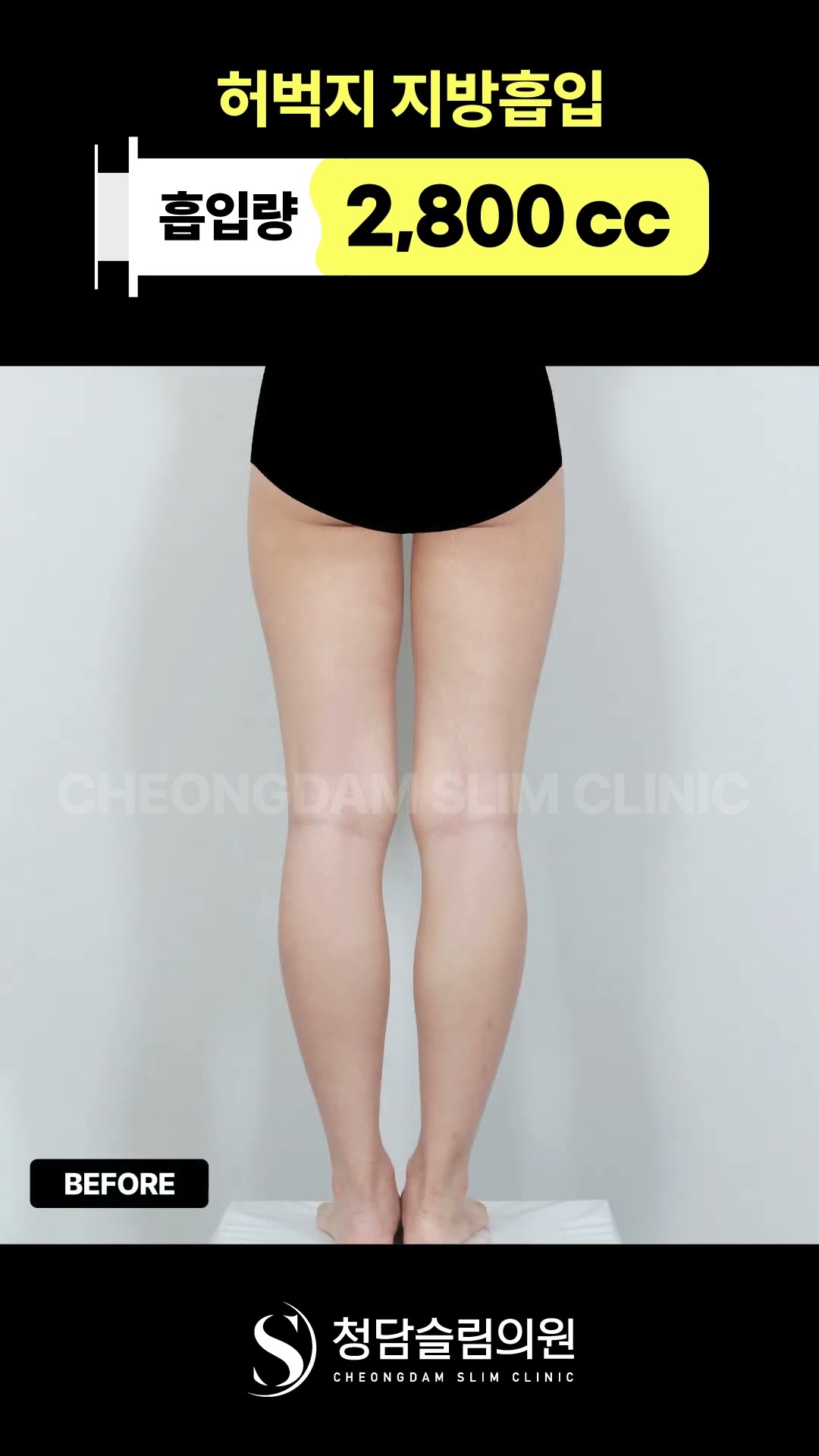 허벅지 라인 바뀌면 이렇게 됩니다 (…
