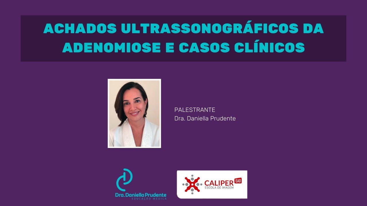 Achados ultrassonográficos na adenomiose - com Dra. Daniella Prudente