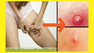 How To Get Rid Of Boils On Inner Thighs And Buttocks | Get rid of boils FAST