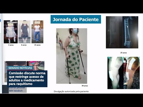 Debatedores na CDH defendem ampliar uso de medicamento contra raquitismo