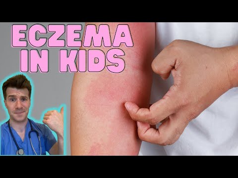 Everything you need to know about Eczema in kids! Causes, symptoms, treatment & home management