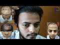 Amazing FUE Hair Transplant Results 6 Months Natural Hair Line Best Hair Transplant Results