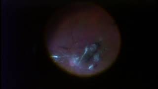 Mammoth Floater Obscures Vision, Creates Glare | 47 YOM | Induce PVD