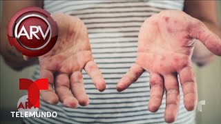 Estado de emergencia por brote de sarampión en NY | Al Rojo Vivo | Telemundo