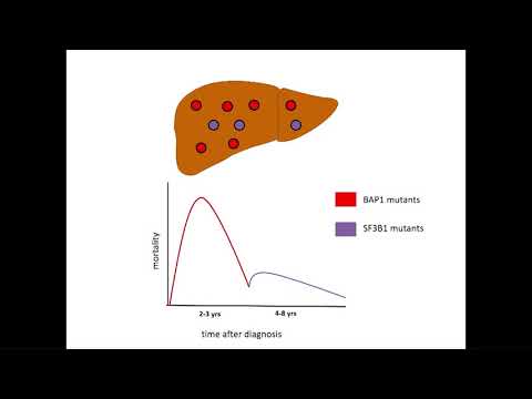 Metastatic Mechanisms of Uveal Melanoma – the Zimmerman Effect by Hans Grossniklaus, MD