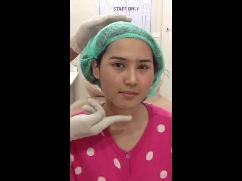 ร้อยไหม หน้าเรียว