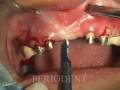 Upper Anterior Esthetic Crown Lengthening and ...