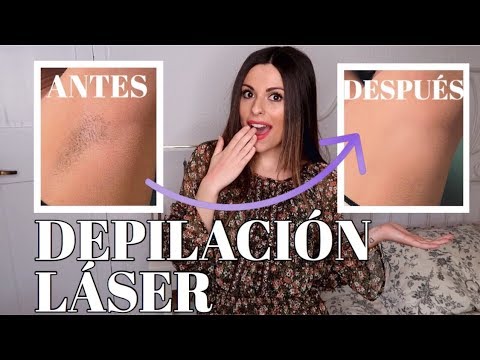 MI EXPERIENCIA DEPILACIÓN LÁSER ¿Funciona? ¿Merece la pena? | Bstyle