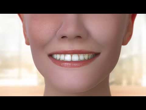 Molen Orthodontics - Bionator