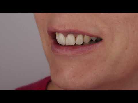 Bonding of ceramic crowns with heated composite | Dental case #3