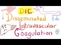 Disseminated Intravascular Coagulation DIC