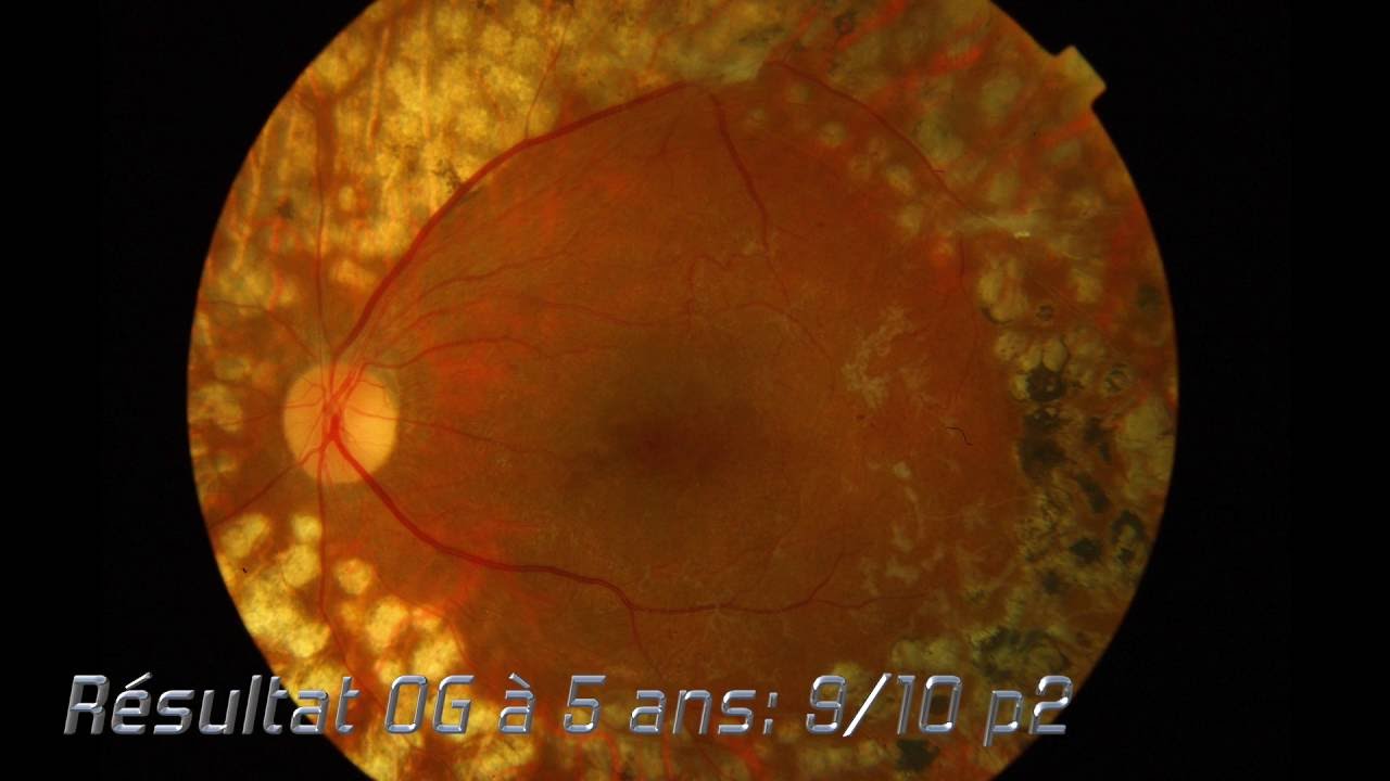 Watch video Rétinopathie diabétique proliférante Rétinopathie diabétique proliférante
