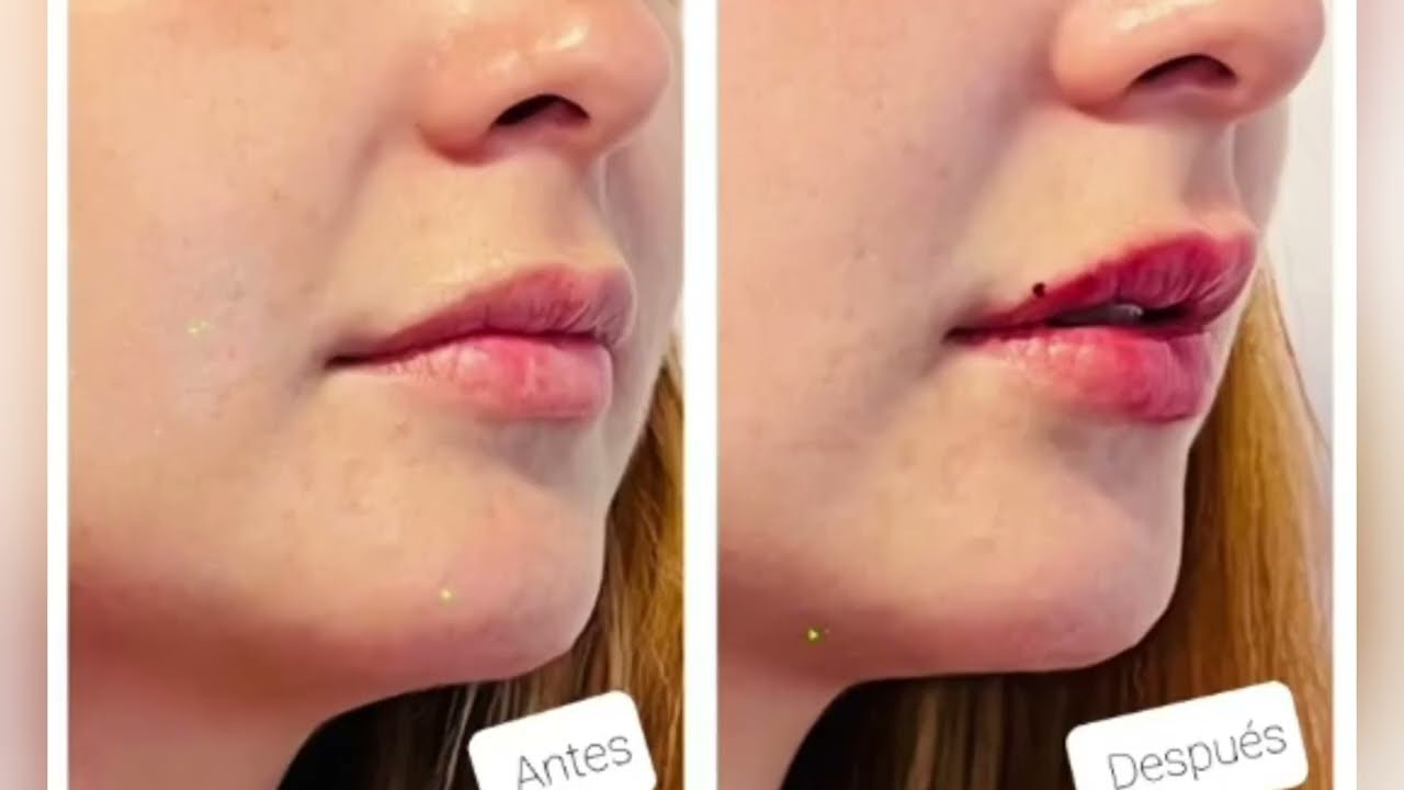 Ácido Hialurónico para relleno en labios