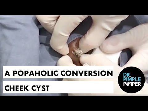 A Popaholic Conversion Cheek Cyst