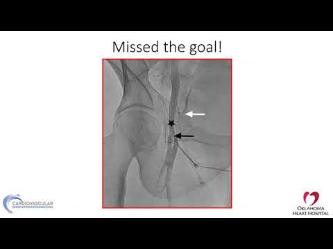 Femoral access: step-by-step and troubleshooting - Mazen Abu-Fadel, MD