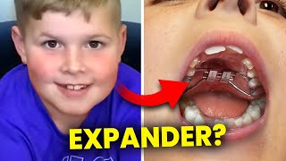 Getting an Expander for Teeth Crowding... | McKinney Orthodontist