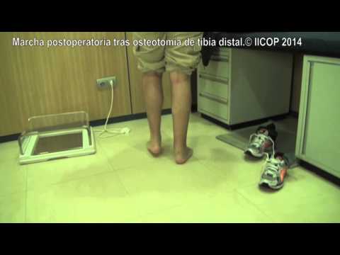 MARCHA POST OPERATORIA TRAS OSTEOTOMIA DE TIBIA DISTAL