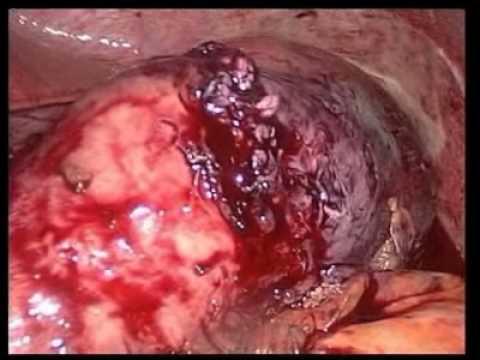 Laparoscopic Management of Gastric Pouch Necrosis Following Gastric Band Slippage