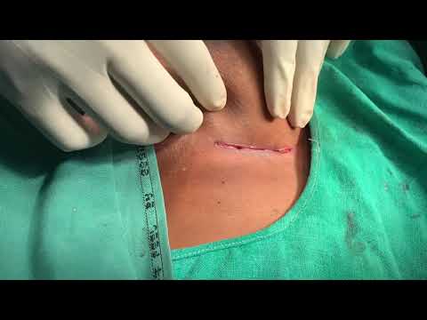 Valsalva Manoeuvre After Cartilaginous Rib Harvest By Breast Augmentation Scarless Incision
