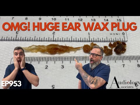 OMG! HUGE EAR WAX PLUG REMOVED - EP953