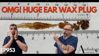 OMG! HUGE EAR WAX PLUG REMOVED - EP953