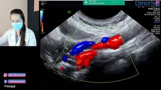 Doppler de Carótidas e Vertebrais.