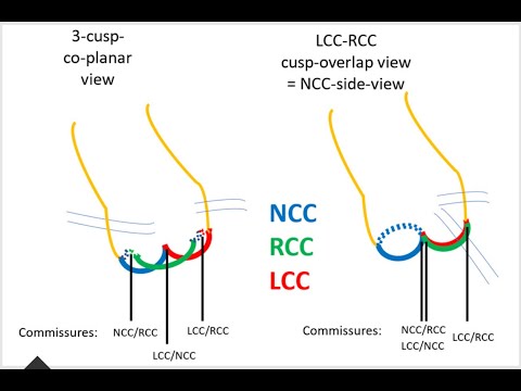 Jenavalve for Severe Aortic Regurgitation (AR): An elegant transcatheter solution (TAVI)