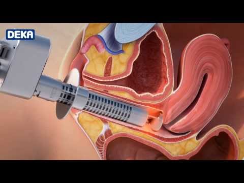 MonaLisa Touch-The New Laser Treatment Against Vaginal Atrophy