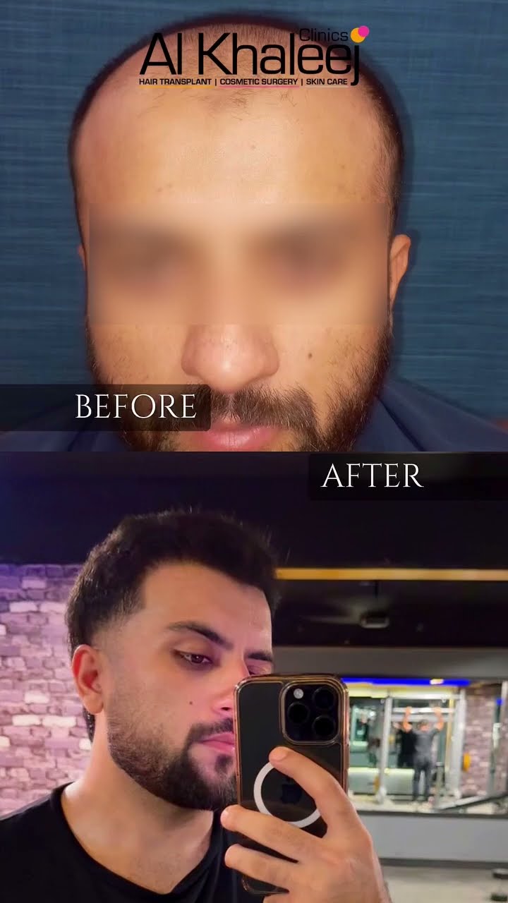 Patient feedback on hair transplant - is it worth it - AlKhaleej Clinics