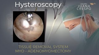 TRS: Myo-Adenomyomectomy