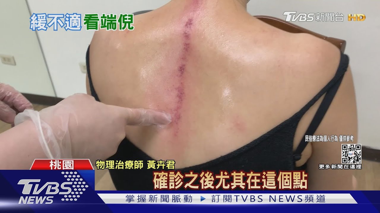 女確診「難喘氣」心肺反射「病毒襲」刮痧深紅