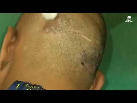 Eczema treatment with hydrocortisone