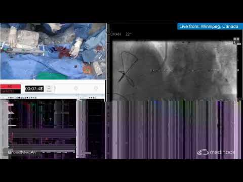 Upfront Orbital Atherectomy With PCI Guided by OCT