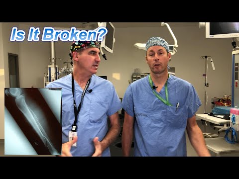 How Do I Know If My Bone is Broken?