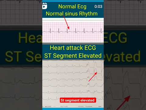 NORMAL Vs ABNORMAL ECG🫀
